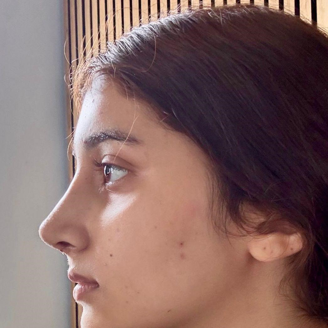 After rhinoplasty in Swat — natural nose surgery result by Dr. Hashmat Ali