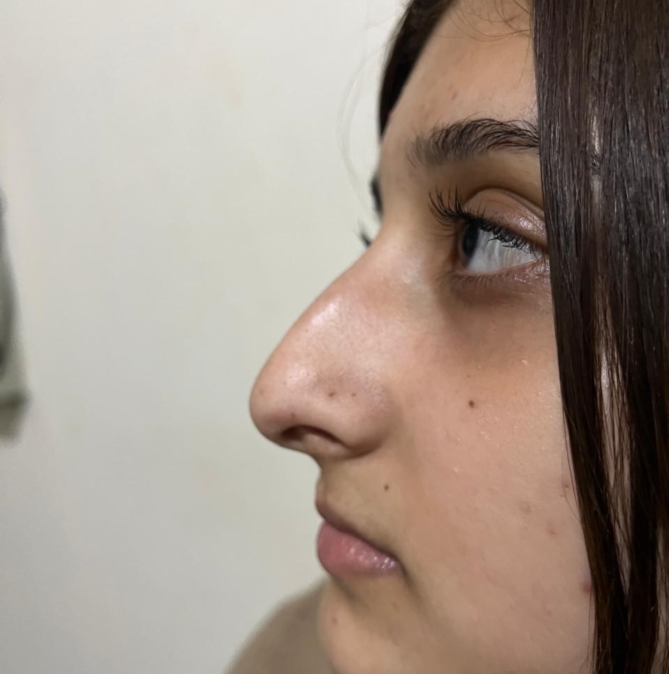 Before rhinoplasty in Swat — patient of Dr. Hashmat Ali