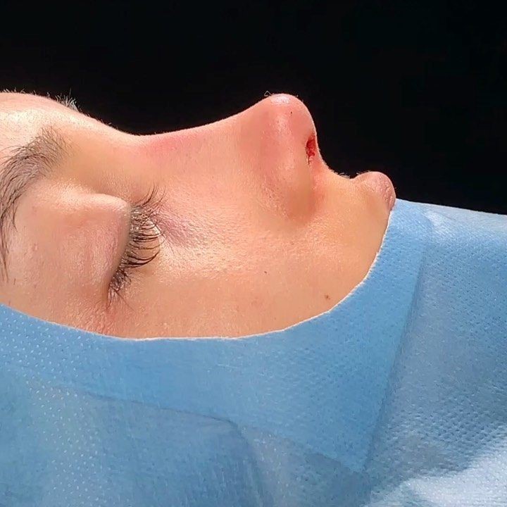 Ultrasonic rhinoplasty results — natural nose surgery in Swat KPK
